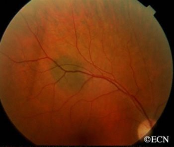 retina eye care center