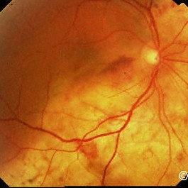 Choroidal osteoma