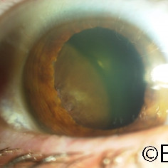 Ciliary body melanoma