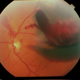 Choroidal Hemorrhage