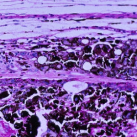 Adenocarcinoma of the retinal pigment epithelium
