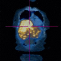 Metastatic choroidal melanoma
