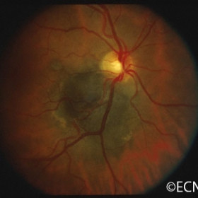 Retinal adenoma