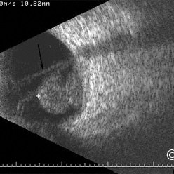 Choroidal melanoma