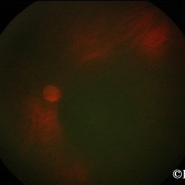 4-lights around a choroidal melanoma