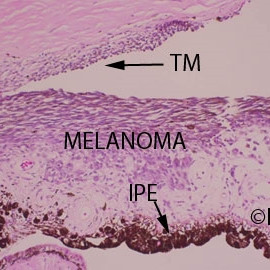 Iris Melanoma