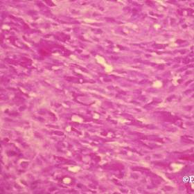 Kaposis sarcoma histology
