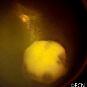 Retinoblastoma
