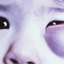 Subcutaneous capillary hemangioma