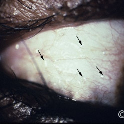 Conjunctival sarcoidosis