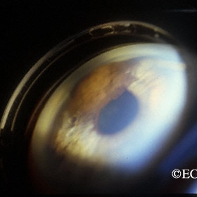 Iris Melanoma