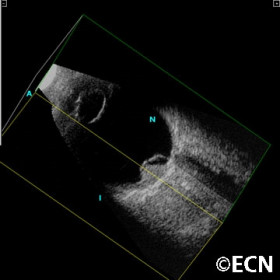Choroidal melanoma