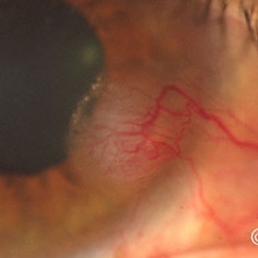 Corneal melanoma