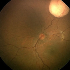 Retinoblastoma endophytic without seeds