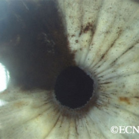 Iris melanoma