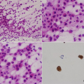 Patient with known metastatic breast cancer presents with bilateral conjunctival metastases.