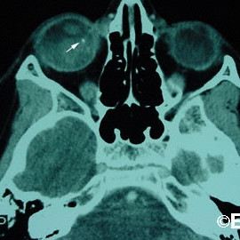 Retinoblastoma