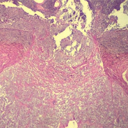 Retinoblastoma invading the optic nerve