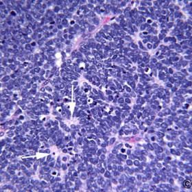 Retinoblastoma