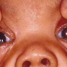 Retinoblastoma leukocoria