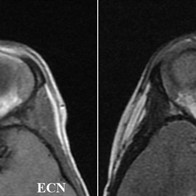 Rhabdomyosarcoma