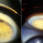 Iridociliary melanoma