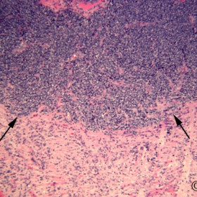 Retinoblastoma
