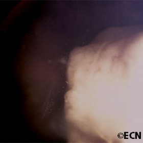 Retinoblastoma seeds