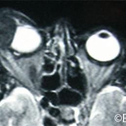 Sarcoma