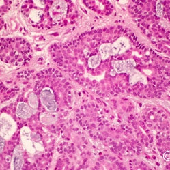 Adenoid cystic carcinoma