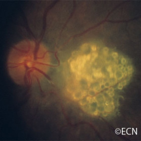 Astrocytic hamartoma