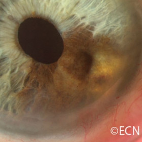 Iridociliary melanoma