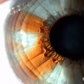 Iris Nevus