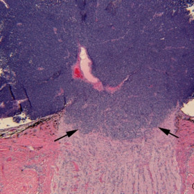 Retinoblastoma
