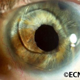 Iridociliary melanoma