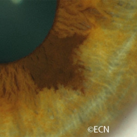 Iris Nevus