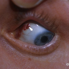 Lymphangioma of the conjunctiva