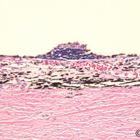 Retinoblastoma