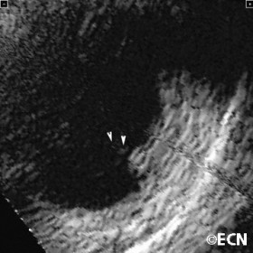 Retinoblastoma with vitreous seeds