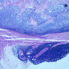 Retinoblastoma