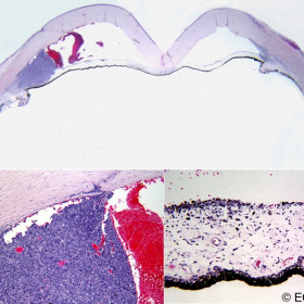 Ring Melanoma