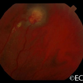 Von Hippel angioma