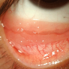 Lymphoma of the conjunctiva