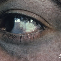 Nevus of Ota
