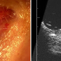 Eyelid Hydrocystoma