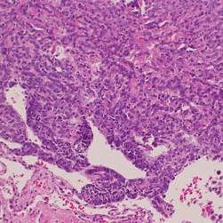 Wilm`s Tumor