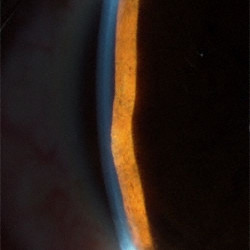Neuroepithelial iris cyst