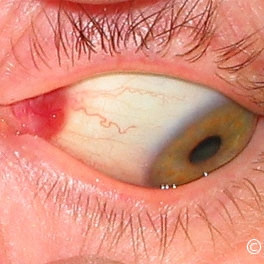 Oncocytoma
