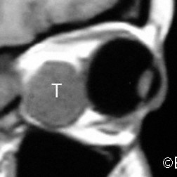 Choroidal Melanoma