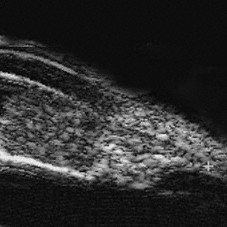 Iridociliary melanoma (20 MHz ultrasound)